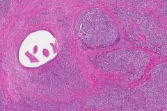 Myoepithelial carcinoma of the parotid gland