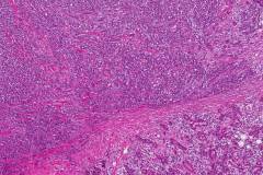 Myoepithelial carcinoma of the parotid gland