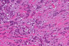 Myoepithelial carcinoma of the parotid gland