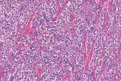 Myoepithelial carcinoma of the parotid gland