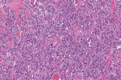 Myoepithelial carcinoma of the parotid gland