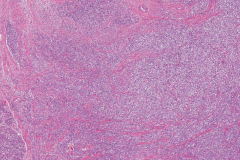 Myoepithelial carcinoma of the parotid gland