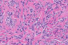 Myofibroblastoma