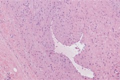 Myopericytoma