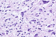 Myxofibrosarcoma