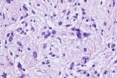 Myxofibrosarcoma