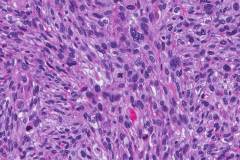 Myxofibrosarcoma