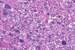 Myxofibrosarcoma