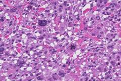 Myxofibrosarcoma