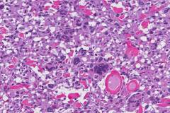 Myxofibrosarcoma