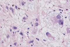 Myxoinflammatory fibroblastic sarcoma