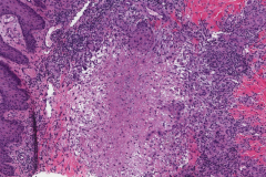 Necrotizing granulomatous inflammation in the skin