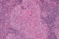 Necrotizing granuloma of the nasal cavity