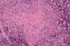 Necrotizing granuloma of the nasal cavity