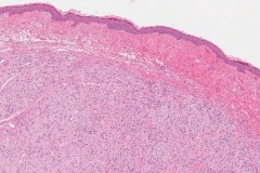 Neurofibroma