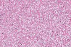 Neurofibroma of the parotid gland
