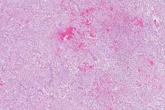 Nodular fasciitis
