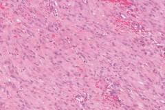 Nodular fasciitis of the breast