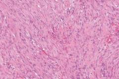 Nodular fasciitis of the breast