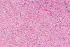 Nodular fasciitis of the breast