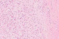 Nodular fasciitis