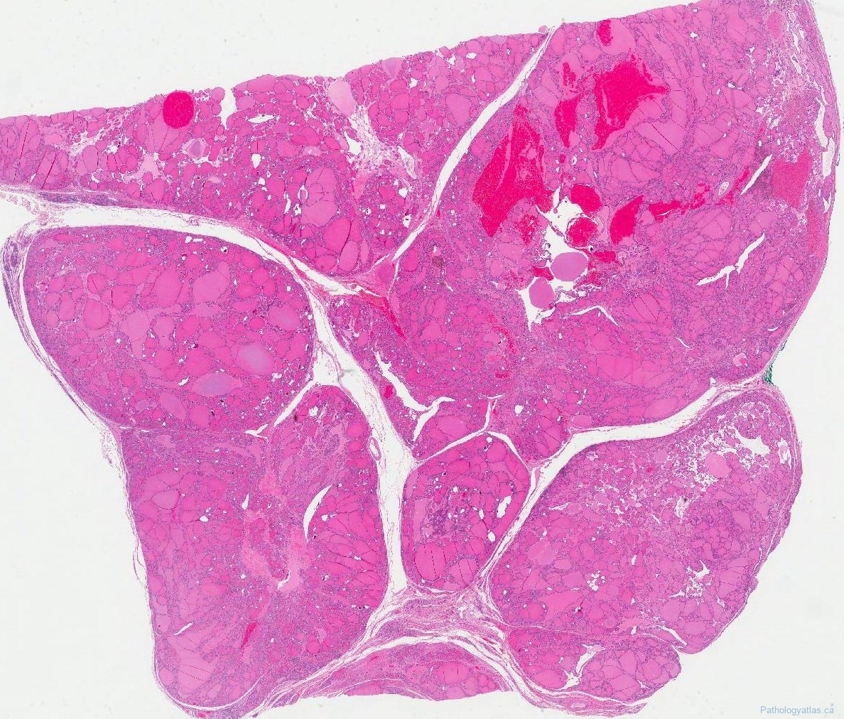 icd 10 code for follicular nodular disease thyroid