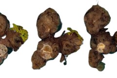 Nodular follicular disease of the thyroid gland