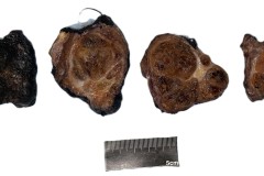 Nodular follicular disease of the thyroid gland