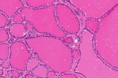 Nodular follicular disease of the thyroid gland