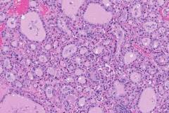 Nodular follicular disease of the thyroid gland