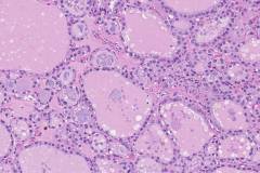 Nodular follicular disease of the thyroid gland