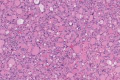 Nodular follicular disease of the thyroid gland