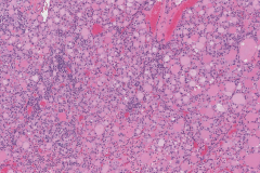 Nodular follicular disease of the thyroid gland