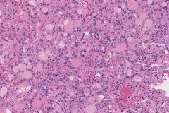 Nodular follicular disease of the thyroid gland