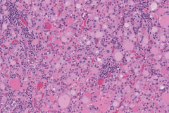 Nodular follicular disease of the thyroid gland