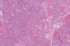 Nodular follicular disease of the thyroid gland
