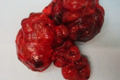 Nodular follicular disease of the thyroid gland