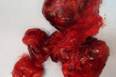 Nodular follicular disease of the thyroid gland