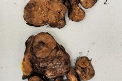 Nodular follicular disease of the thyroid gland