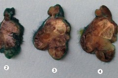 Nodular follicular disease of the thyroid gland: Adenomatoid nodule with degenerative changes.