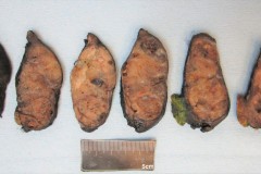 Nodular follicular disease of the thyroid gland
