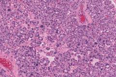 Nodular thyroid hyperplasia with endocrine atypia