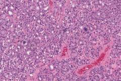 Nodular thyroid hyperplasia with endocrine atypia