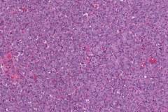Non-invasive follicular thyroid neoplasm with papillary-like nuclear features (NIFTP)