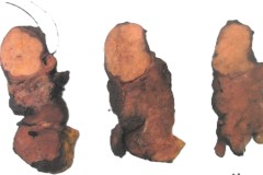 Non-invasive follicular thyroid neoplasm with papillary-like nuclear features (NIFTP)
