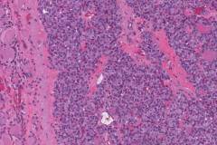Non-invasive follicular thyroid neoplasm with papillary-like nuclear features (NIFTP)