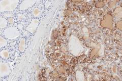 Non-invasive follicular thyroid neoplasm with papillary-like nuclear features: Immunohistochemistry for HBME-1