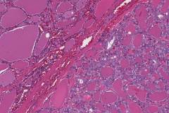 Non-invasive follicular thyroid neoplasm with papillary-like nuclear features