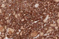 Non-invasive follicular thyroid neoplasm with papillary-like nuclear features: Immunohistochemistry for HBME-1