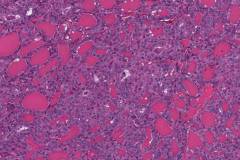 Non-invasive follicular thyroid neoplasm with papillary-like nuclear features